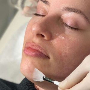 peeling facial